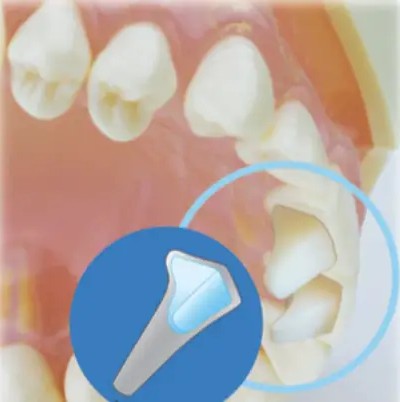 Mini Mold® Starter Kit