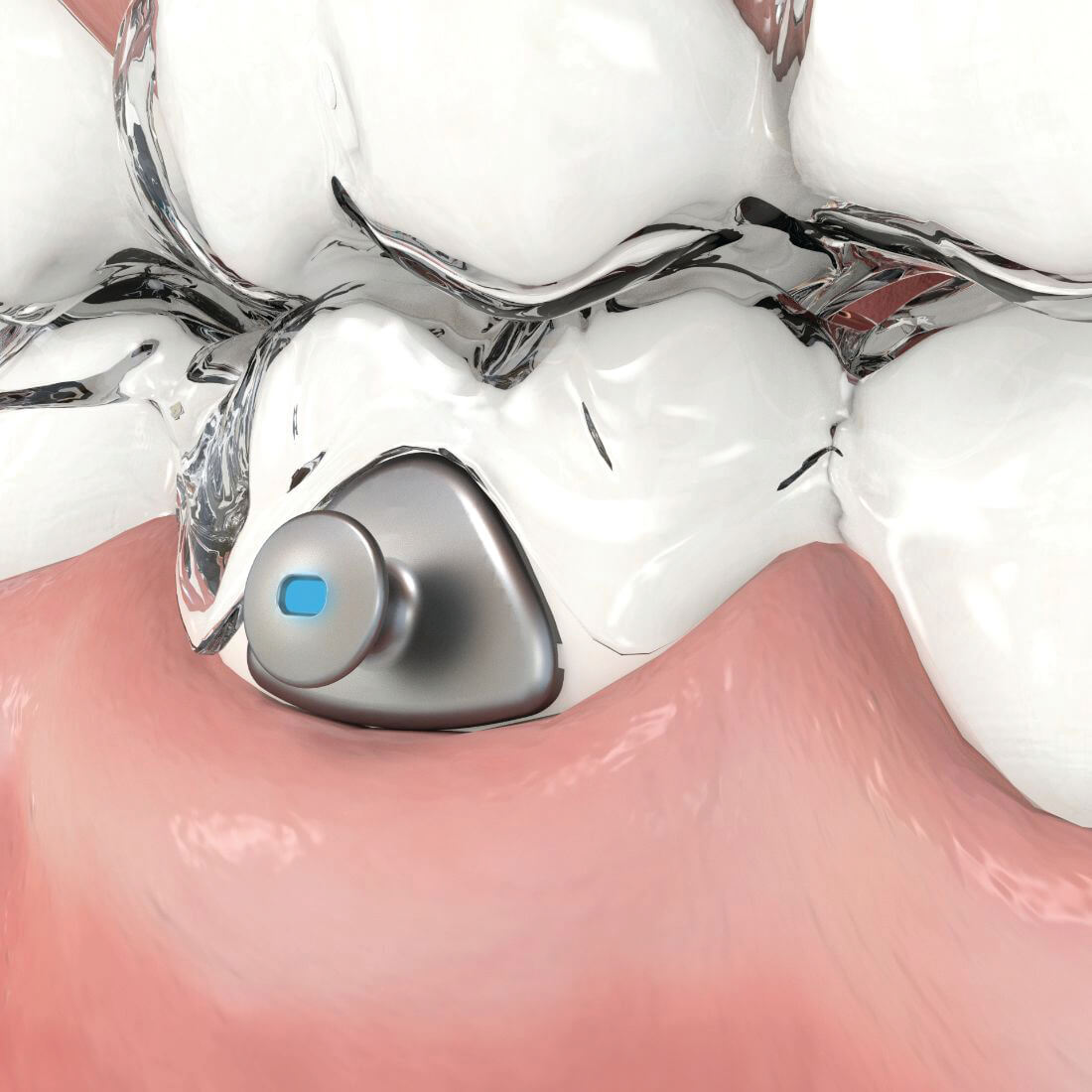 Aligner Buttons, transparent