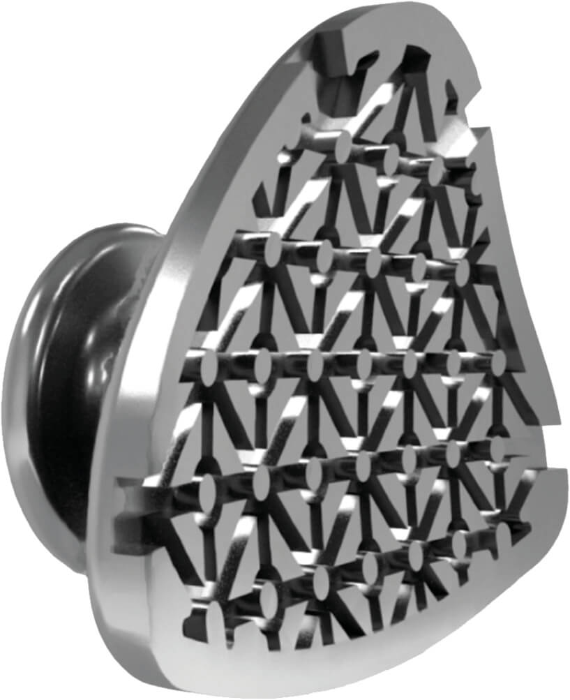 Aligner Buttons, Metall