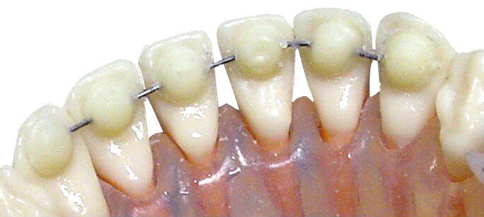 Mini Mold® Retainer, klein