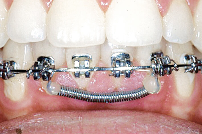 Huckepackfeder Einzelbox F2, rot