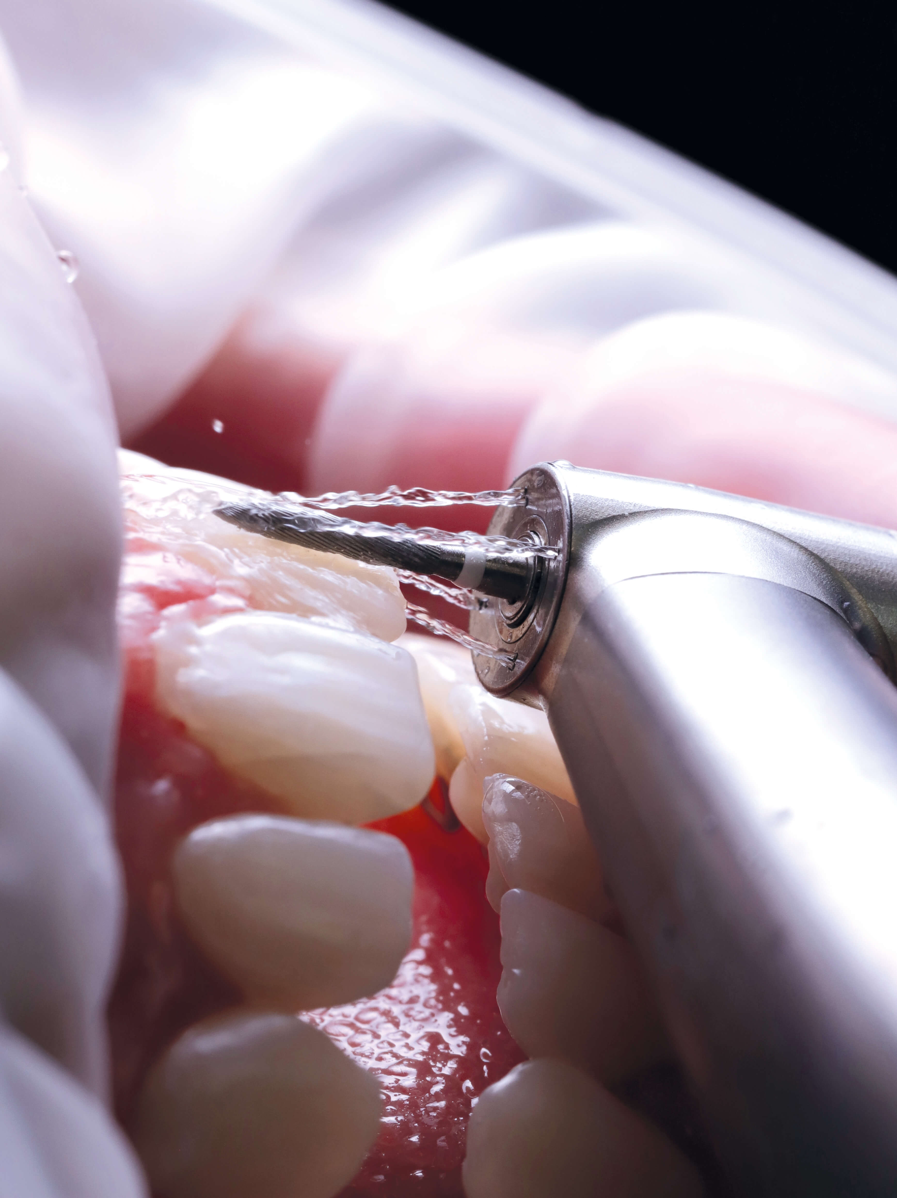Hartmetall Fräse (Winkelstück), Interdental & Gingivanah, 016